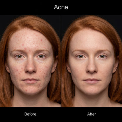 Red Light Therapy Mask